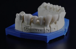 种植牙的五大危害