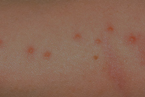 螨虫叮咬后的症状图