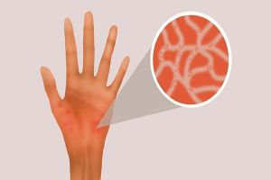 荨麻疹为什么晚上发作