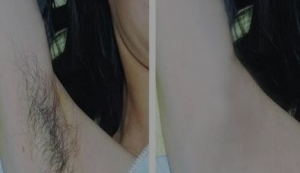 激光脱毛6年后后悔了