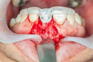 牙龈癌的早期三大症状