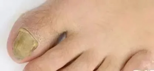 灰指甲最怕三个克星