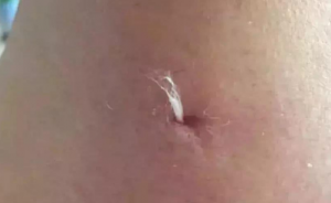 挑羊毛疔是真的假的