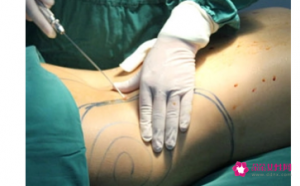 抽脂可不可以减肥